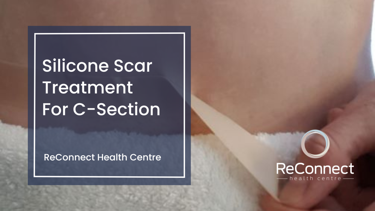 Silicone Scar Treatment for CSections ReConnect Health Center Moncton NB